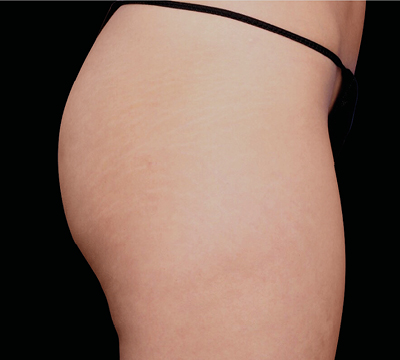 neo-beforeafter-main2