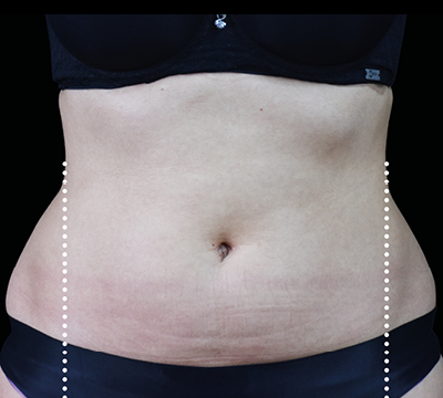 neo-beforeafter-main5