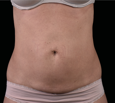 neo-beforeafter-main6