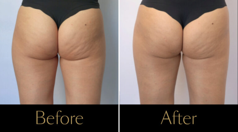 rakus-beforeafter-cellution-gallery
