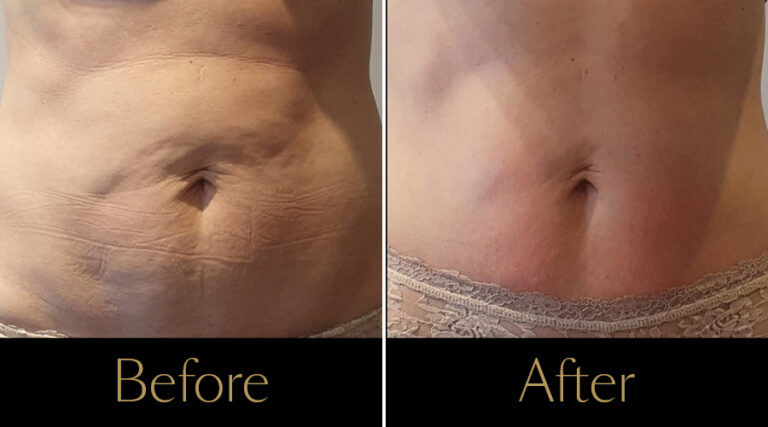 rakus-beforeafter-cellution-gallery3