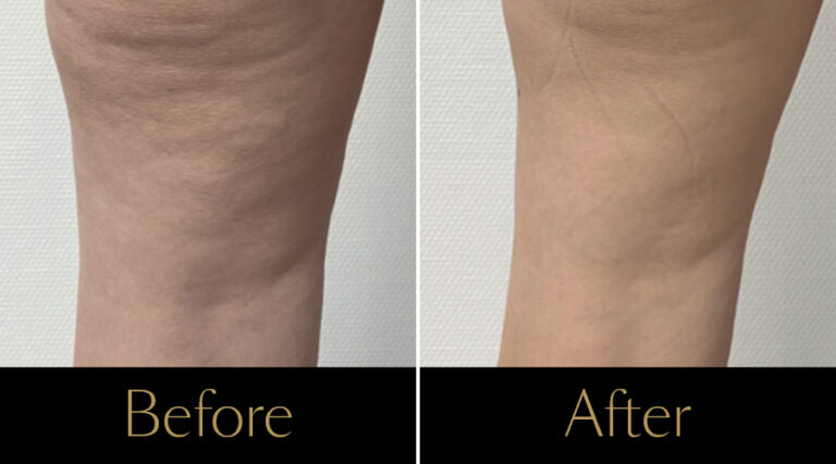 rakus-beforeafter-cellution-gallery4