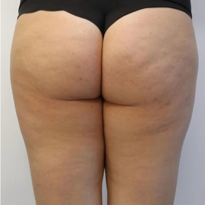 rakus-beforeafter-cellution