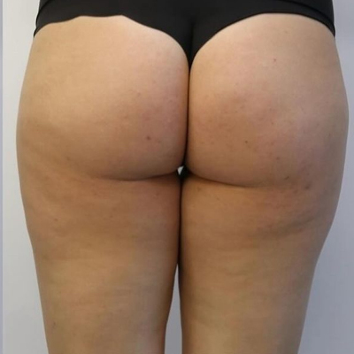 rakus-beforeafter-cellution2