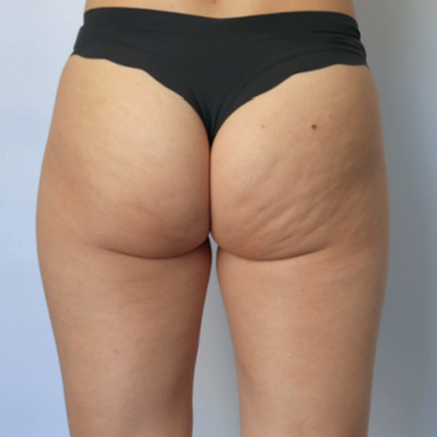 rakus-beforeafter-cellution3