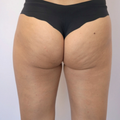 rakus-beforeafter-cellution4