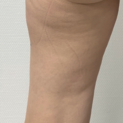 rakus-beforeafter-cellution8