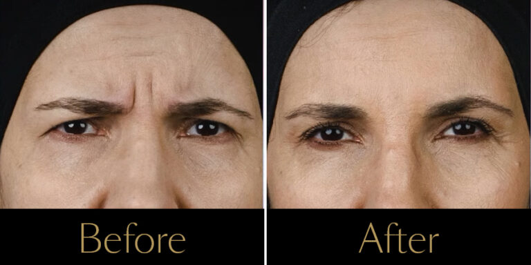 rakus-botox-beforeafter-gallery3