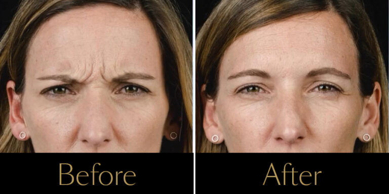rakus-botox-beforeafter-gallery4