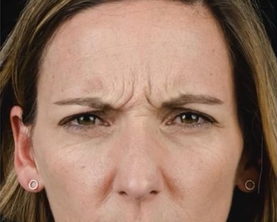 rakus-botox-gallery3