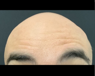 rakus-botox-gallery7