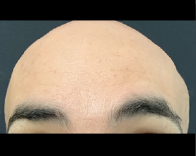 rakus-botox-gallery8