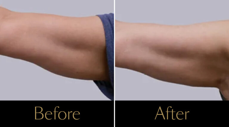 rakus-cristalpro-beforeafter-gallery