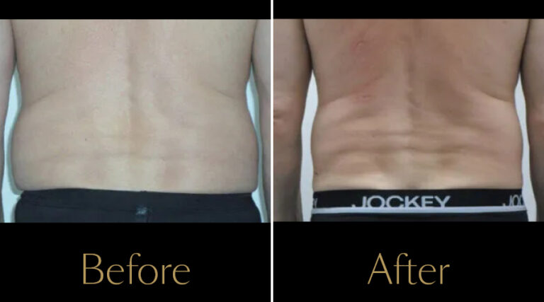 rakus-cristalpro-beforeafter-gallery3