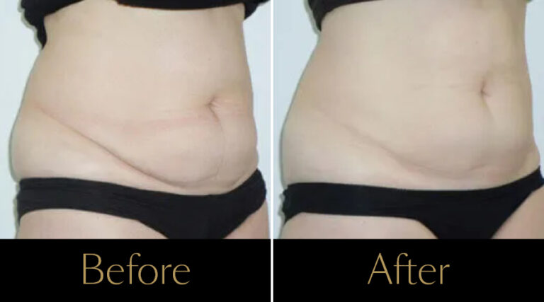 rakus-cristalpro-beforeafter-gallery4