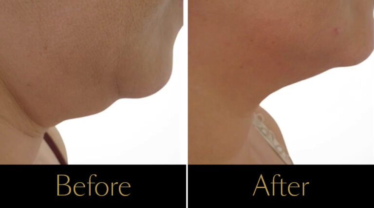 rakus-cristalpro-beforeafter-gallery5