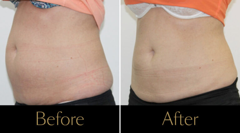 rakus-cristalpro-beforeafter-gallery6