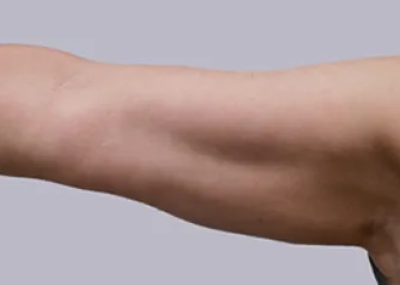 rakus-cristalpro-beforeafter4