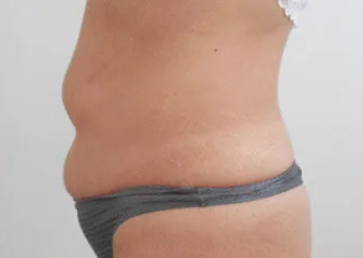 rakus-cristalpro-beforeafter5