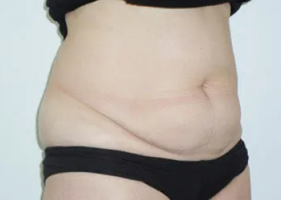 rakus-cristalpro-beforeafter7