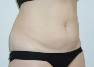 rakus-cristalpro-beforeafter8