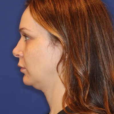 rakus-emface-beforeafter