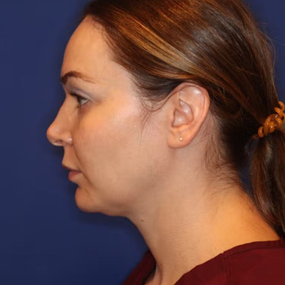 rakus-emface-beforeafter2