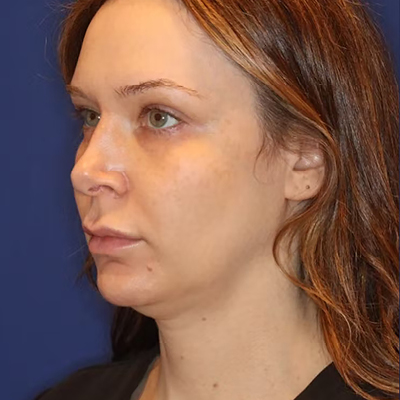 rakus-emface-beforeafter3