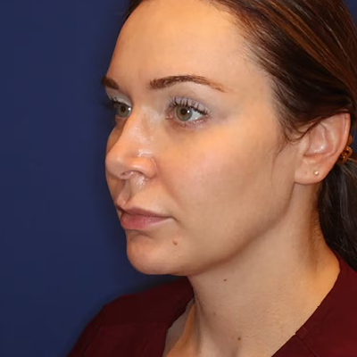 rakus-emface-beforeafter4