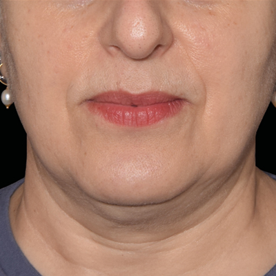 rakus-emface-beforeafter6