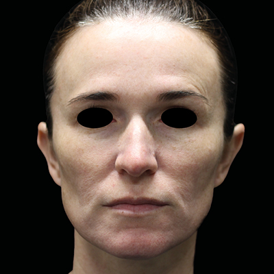 rakus-emface-beforeafter7