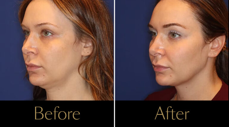 rakus-emface-beforeaftergallery