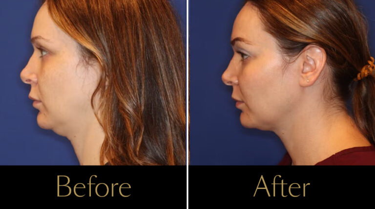 rakus-emface-beforeaftergallery2