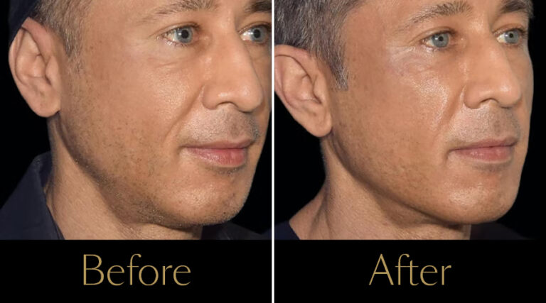 rakus-emface-beforeaftergallery3