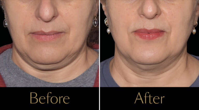 rakus-emface-beforeaftergallery4