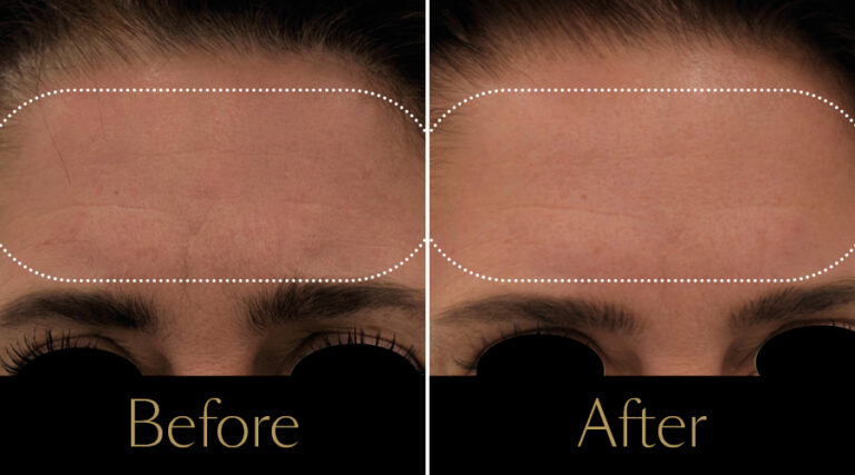 rakus-emface-beforeaftergallery6