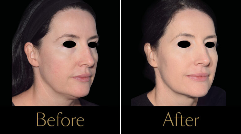 rakus-emface-beforeaftergallery7