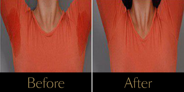 rakus-excesssweating-ba