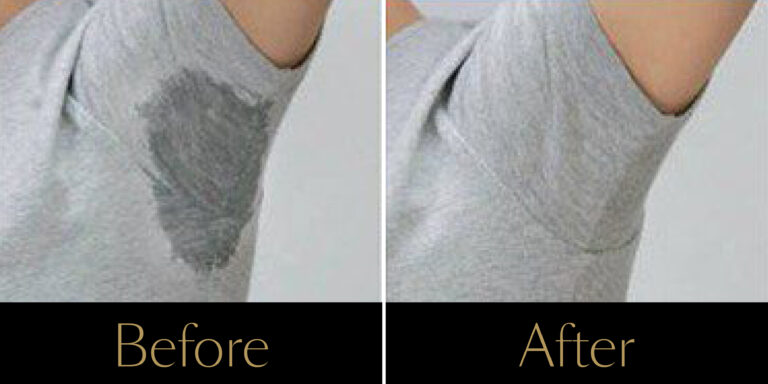 rakus-excesssweating-ba2