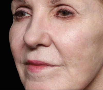 rakus-exion-beforeafter4