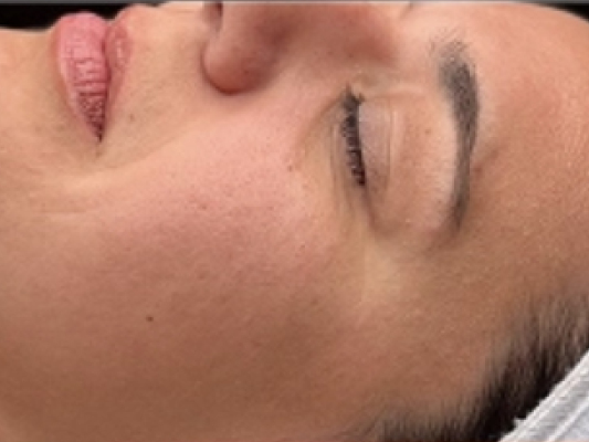 rakus-hydrafacial-beforeafter3