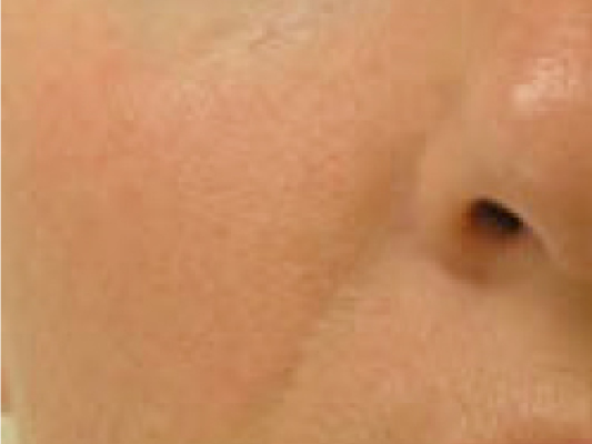 rakus-hydrafacial-beforeafter8