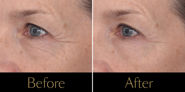 rakus-hydrafacial-gallery