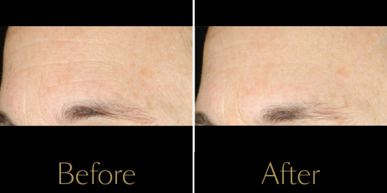 rakus-hydrafacial-gallery3