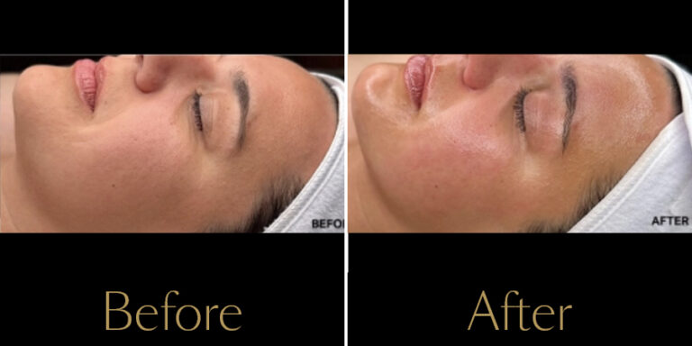 rakus-hydrafacial-gallery4