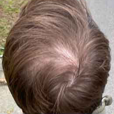 rakus-keravive-beforeafter