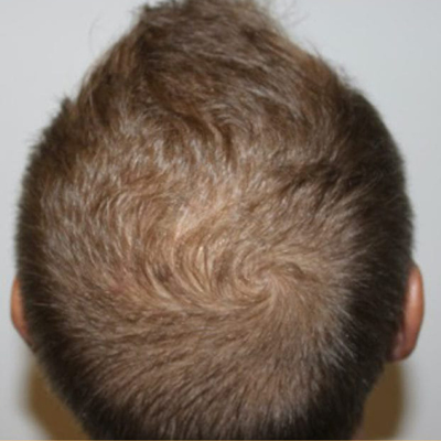 rakus-keravive-beforeafter5