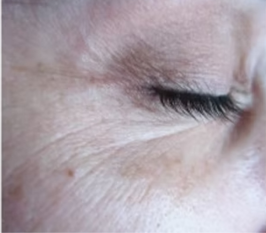 rakus-pelleve-beforeafter-eyes