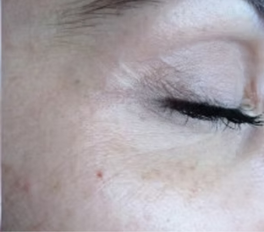 rakus-pelleve-beforeafter-eyes2