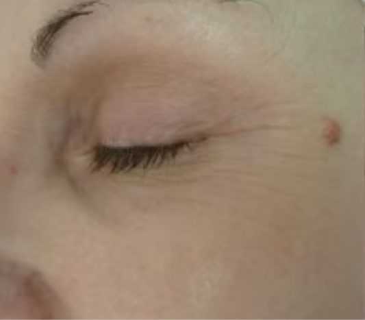 rakus-pelleve-beforeafter-eyes3